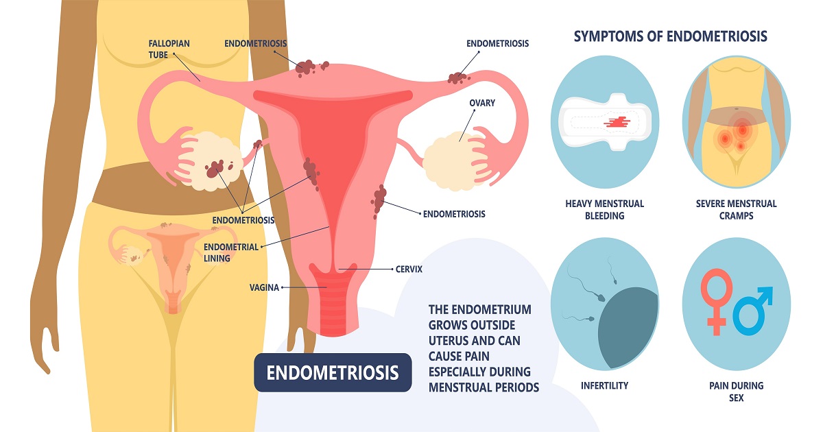 Direct Primary Care - Common symptoms of Endometriosis: - Painful periods -  Pain with intercourse - Pain with bowel movements or urination - Excessive  bleeding (heavy periods, or bleeding in between periods) 