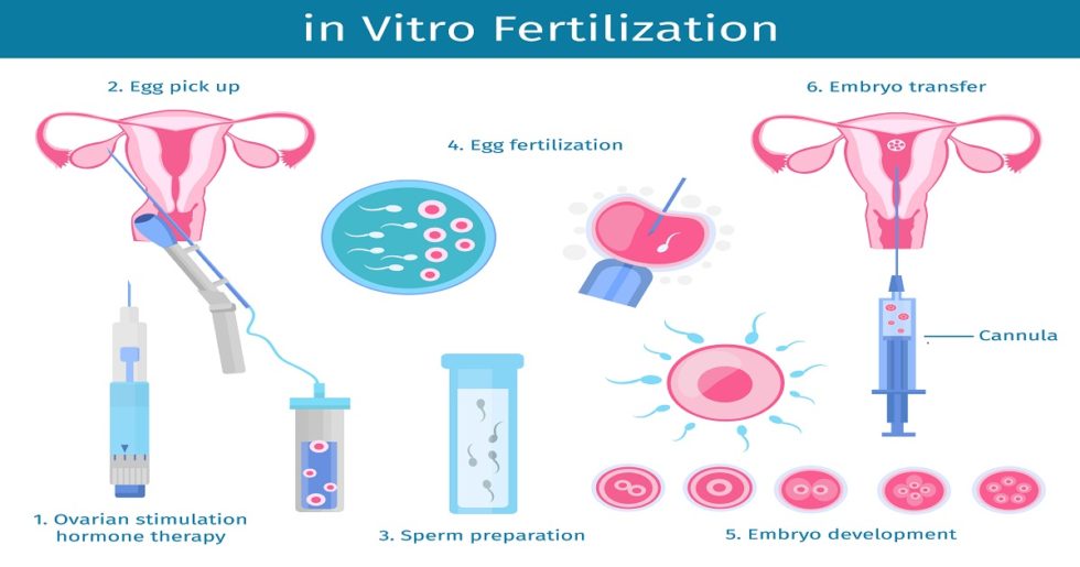 IVF Procedure Step By Step | IVF Process Start To Finish