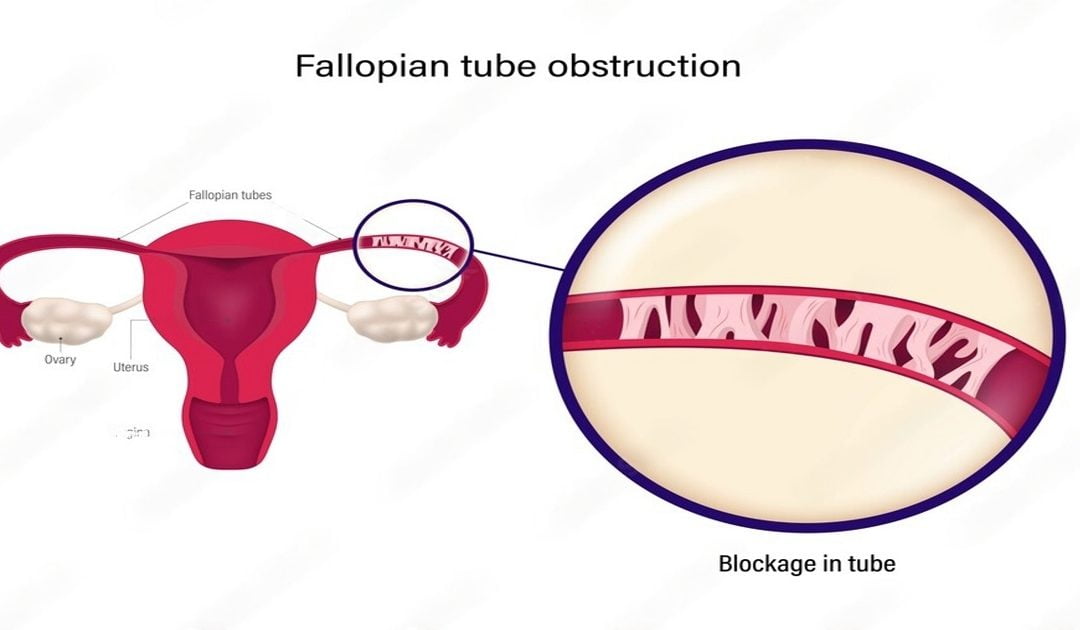 Fallopian Tube Blockage Treatment Options