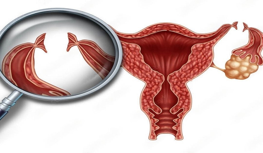 What are Tubectomy and Tubectomy Reversal?