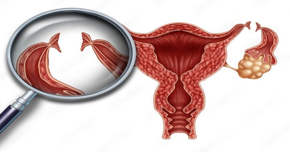 what-are-tubectomy-and-tubectomy-reversal-dr-mona-dahiya