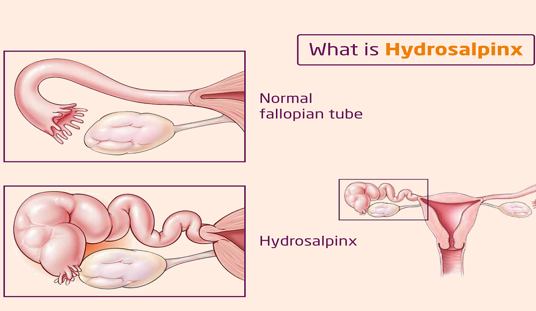 Hydrosalpinx: Symptoms, Causes and Treatment