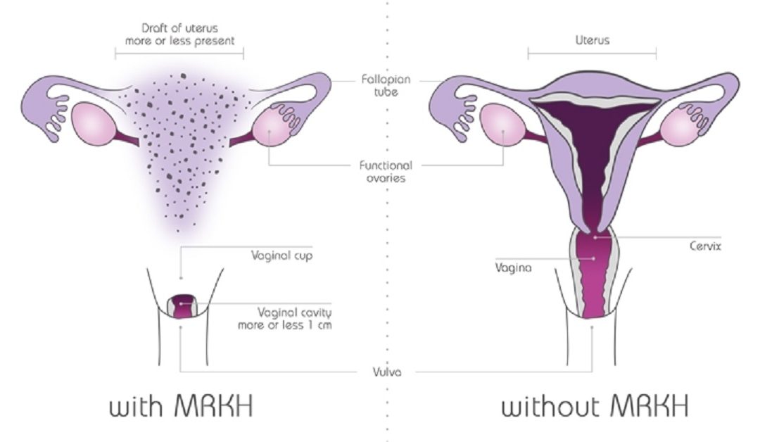 MRKH Syndrome: Symptoms, Causes & Treatment