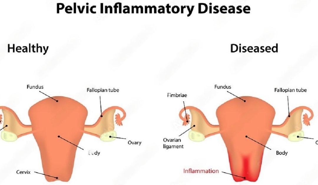 Pelvic Inflammatory Disease (PID): Causes And Treatment